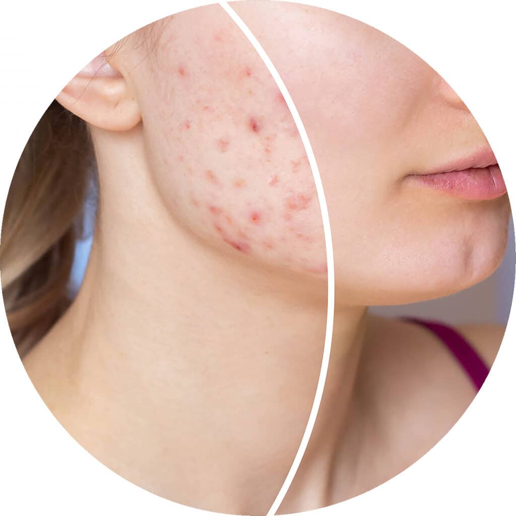 quod alzira valencia 0007 acne Quod Clinic