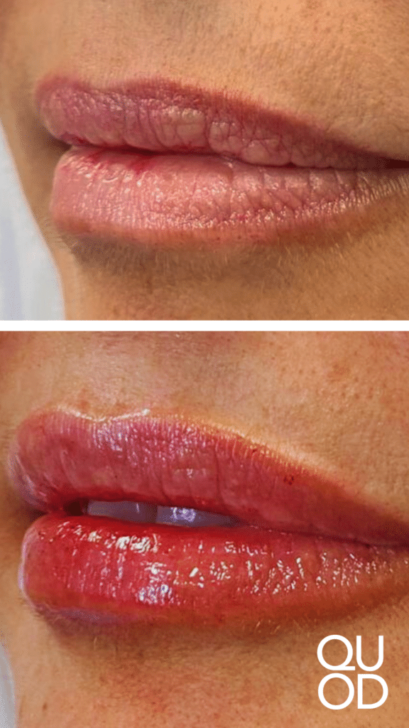 Copia de ¡Dale a tus labios el volumen y la suavidad que siempre has deseado 6 Quod Clinic
